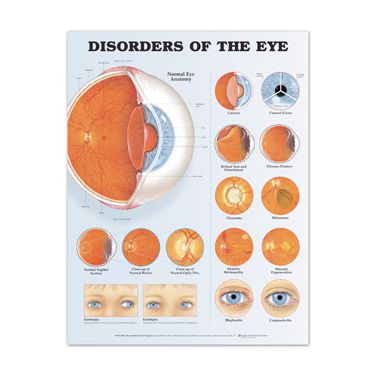 Disorders Of The Eye : Common Eye Diseases and Vision Problems – DKCICX