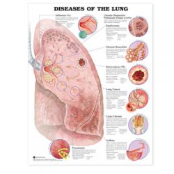 Wandplaat 'Diseases of the Lung'