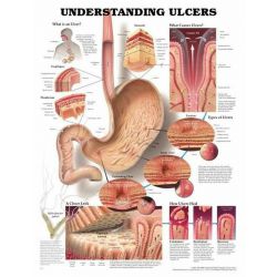 Wandplaat 'Understanding Ulcers'