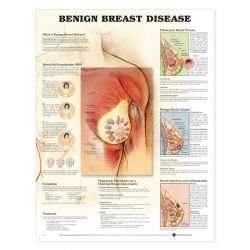 Wandplaat 'Benign Breast Disease' 