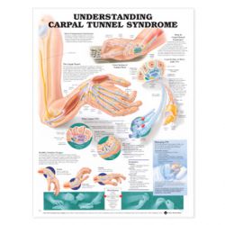 Wandplaat 'Understanding Carpal Tunnel Syndrome'