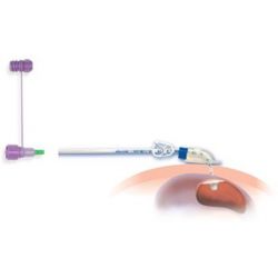 Nutricia Flocare PEG set, CH14, verp. á 5 stuks