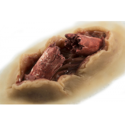 Compound Fracture Dynamic (bleeding, human light skintone)