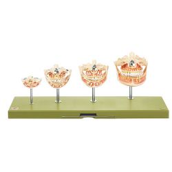 Gebitsontwikkeling, 4 stadia: ES 14/1-1 t/m ES 14/1-4