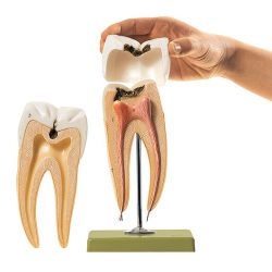 Kies met cariës, 8x vergroot, 3-delig 