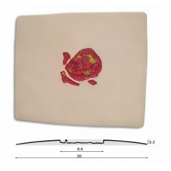 Ulcus Cruris, open been wond