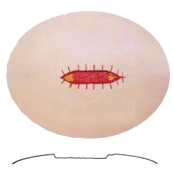 Chirurgische wond model A