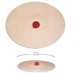 Stoma model B