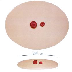 Stoma model C