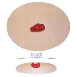 Stoma model D