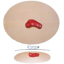 Stoma model E