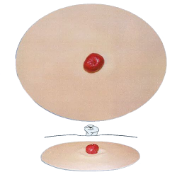 Stoma model G