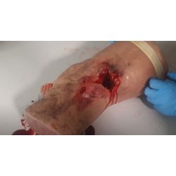 Been voor wondpakking en tourniquet plaatsen