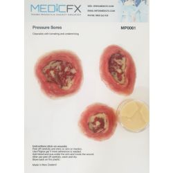 Sheet met 4 decubituswonden en potje gele pus