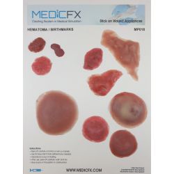 Verschillende hematomen / moedervlekken