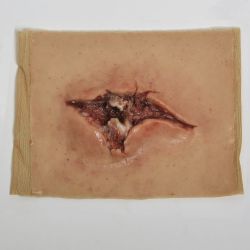 Open fractuur - sleeve