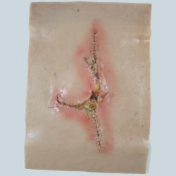 Grote geïnfecteerde wond - sleeve
