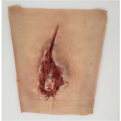 Open pols fractuur, sleeve