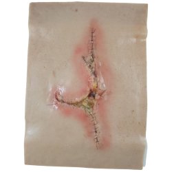 Grote geïnfecteerde wond - sleeve