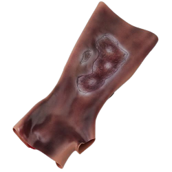 2e en 3e graads brandwonden onderarm