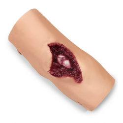 Gecompliceerde bovenarmbreuk