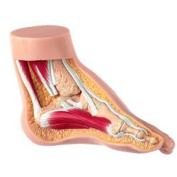 Model van een klompvoet