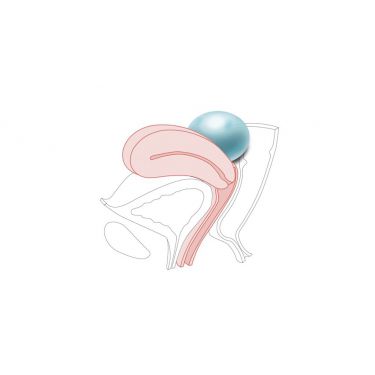 CFPT Module 4: Ovarium Cyste