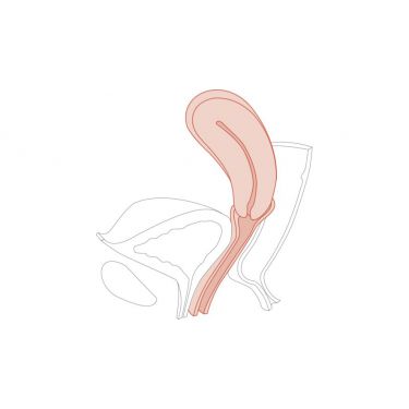 CFPT Module 5: Uterus in retroversie