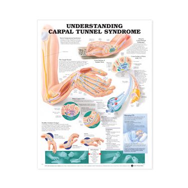 Wandplaat 'Understanding Carpal Tunnel Syndrome'
