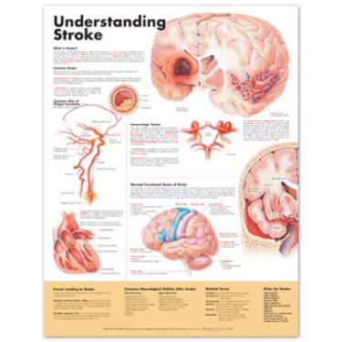 Wandplaat 'Understanding Stroke'