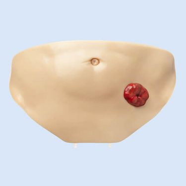 Buikdeksel met 5-delige stoma set