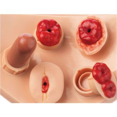 5-delige stoma set