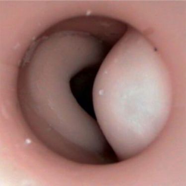 Rectal Examination Perineum - Pathology