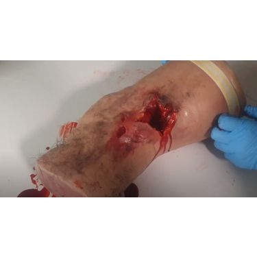 Been voor wondpakking en tourniquet plaatsen