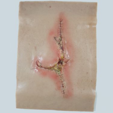 Grote geïnfecteerde wond - sleeve
