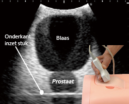 Intravesicale Urine Volume meetinstrument