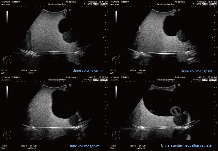 Intravesicale Urine Volume meetinstrument